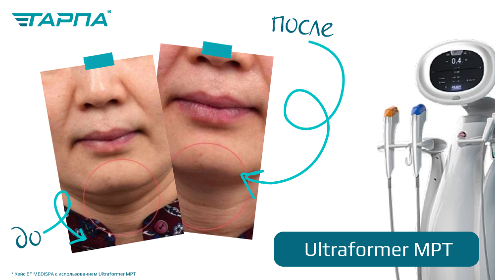 Безоперационный лифтинг нового поколения: Ultraformer MPT